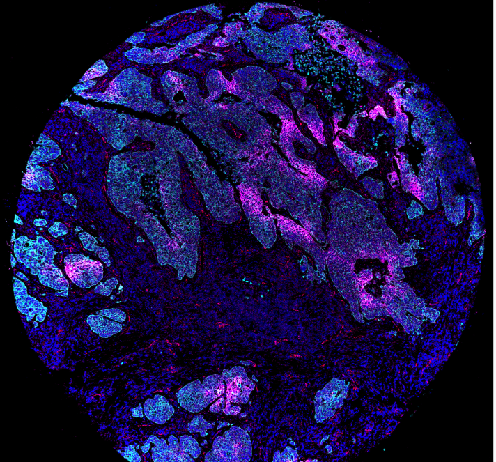 tumour, with tumour cells in cyan and proteins they have expressed to handle low oxygen environments in pink 