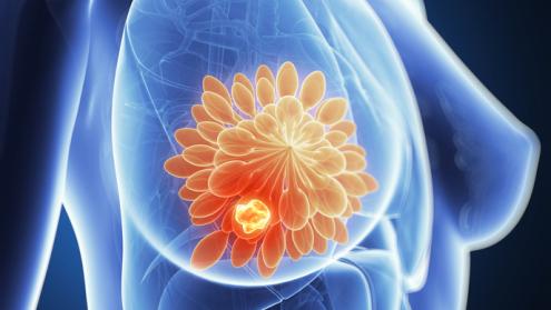 Understanding cancer development and prevention in genetically predisposed women