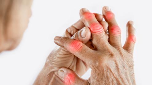 MRI facilitates diagnosis of preclinical rheumatoid arthritis