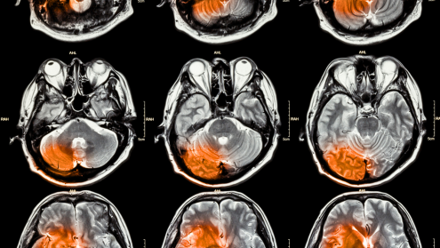 Repairing the brain after a stroke 