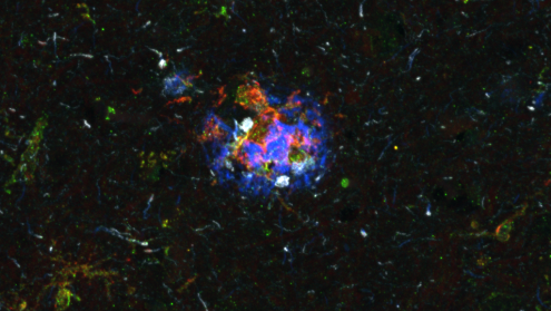 Antigen-presentation by microglia at an advanced neuritic plaque in Alzheimer's disease (microglia, green; MHC-II, red; Aß, blue; pTau, grey).