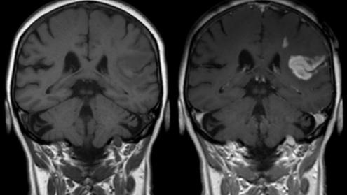 Cover image of Our brain has a barrier that stops drugs. How do we get past it?