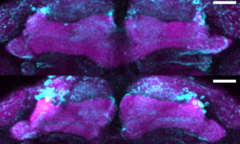 New mutation linked to early-onset Parkinsonism New mutation linked to early-onset Parkinsonism