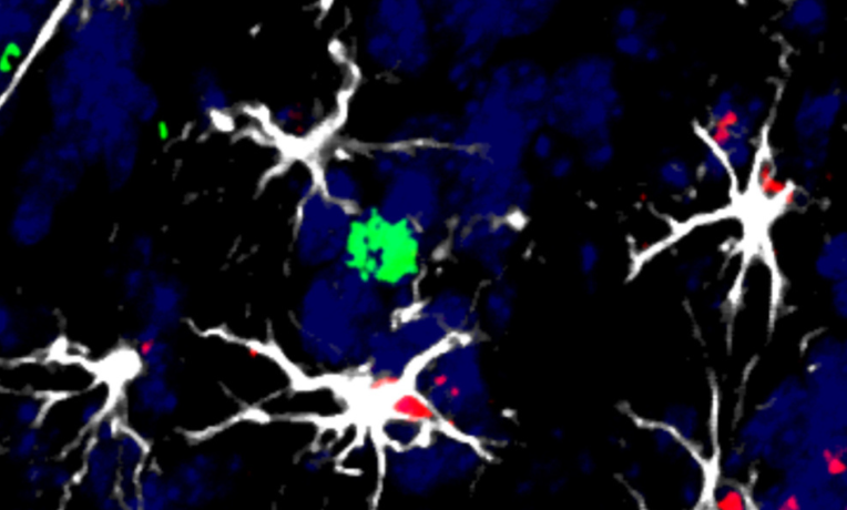CNIO researchers propose a new treatment for brain metastasis based on immunotherapy CNIO researchers propose a new treatment for brain metastasis based on immunotherapy