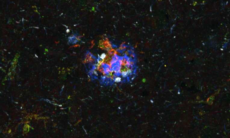 Antigen-presentation by microglia at an advanced neuritic plaque in Alzheimer's disease (microglia, green; MHC-II, red; Aß, blue; pTau, grey).