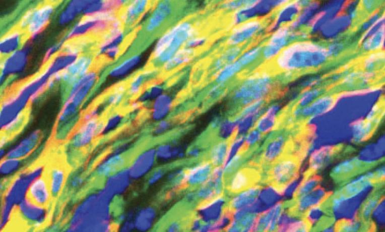 Cover image of Breakthrough discovery in cancer research funded by the ERC Cover image of Breakthrough discovery in cancer research funded by the ERC