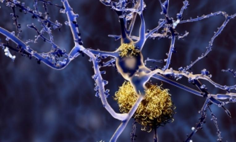 Cover image of New understanding of how Alzheimer’s develops Cover image of New understanding of how Alzheimer’s develops