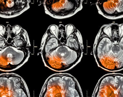 Repairing the brain after a stroke 