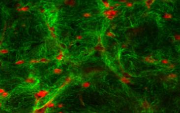 Cover image of A new weapon against pancreatic cancer on the way ?