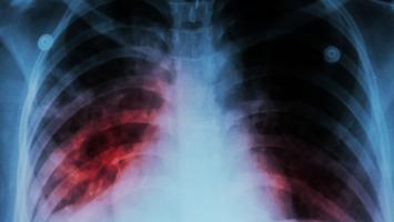 New insights into mechanics of TB transmission brings control closer