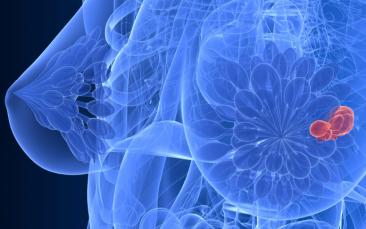 Cover image of Innovative EU research targets breast cancer