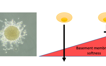 Cover image of New scientific discovery may enable accurate prediction of cancer spread even before cancer develops