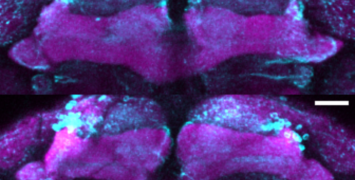 New mutation linked to early-onset Parkinsonism