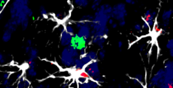 CNIO researchers propose a new treatment for brain metastasis based on immunotherapy