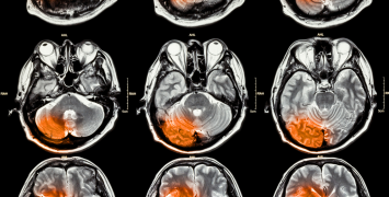 Repairing the brain after a stroke 