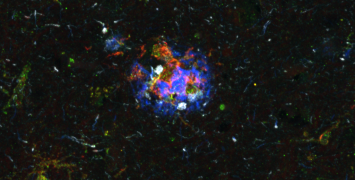 Antigen-presentation by microglia at an advanced neuritic plaque in Alzheimer's disease (microglia, green; MHC-II, red; Aß, blue; pTau, grey).