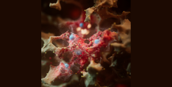 artistic representation of the internal surface of an inflamed alveolus, with significant accumulation of damage that ultimately leads to the release of a 1