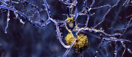 Cover image of New understanding of how Alzheimer’s develops